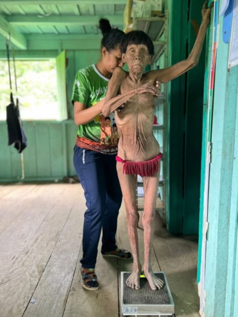 O colapso indígena e seu marco temporal

Homem e mulher Yanomami desnutridos recebem atendimento médico nas Terras Indígenas Yanomami