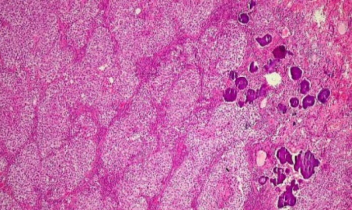 Imagem de germinoma ao microscópio, exemplo de tumor de células germinativas estudado em pesquisas sobre câncer infantil raro.