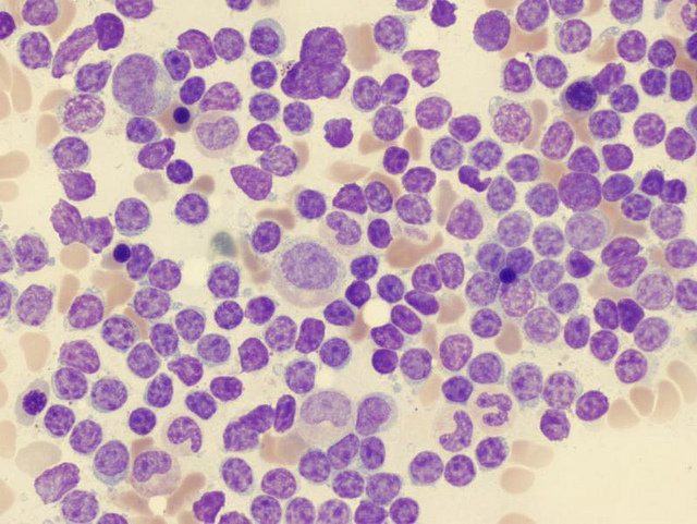 Células de leucemia mieloide crônica observadas ao microscópio, associadas aos estudos sobre o tratamento da leucemia
